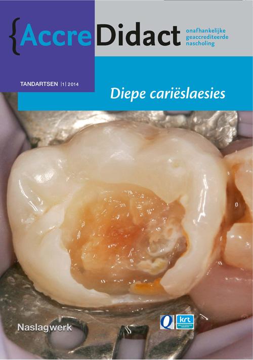 Diepe carieslaesies / Accre...